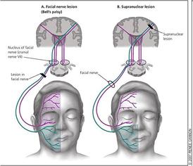 Schema delle proiezioni corticali al nucleo motore del nervo facciale. La metà superiore del nucleo riceve proiezioni da entrambi gli emisferi cerebrali, mentre la metà inferiore solo da un lato.