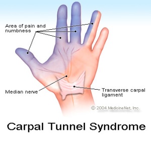Il nervo mediano dà rami sensitivi a tutta la superficie palmare delle prime tre dita della mano, più metà del quarto dito. Proprio in queste zone si percepiscono i sintomi di intorpidimento, formicolio, dolore, soprattutto notturni.